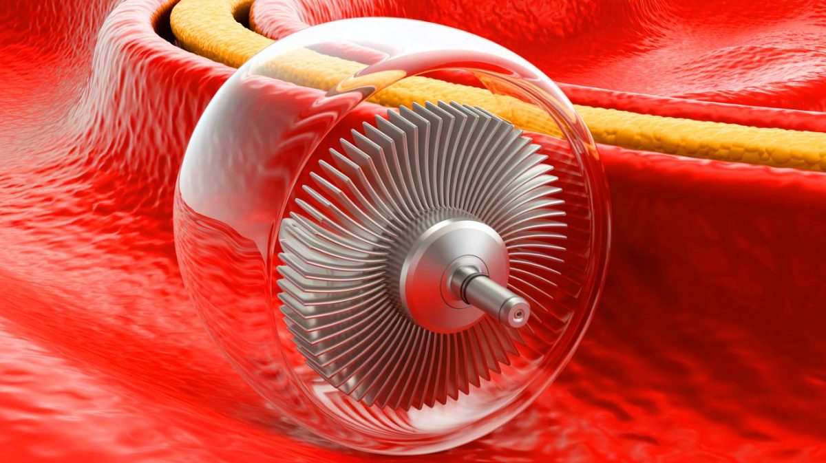 Illustration de l'innovation médicale du milli-spinner conçu pour traiter les caillots sanguins. Image réalisée par IA.